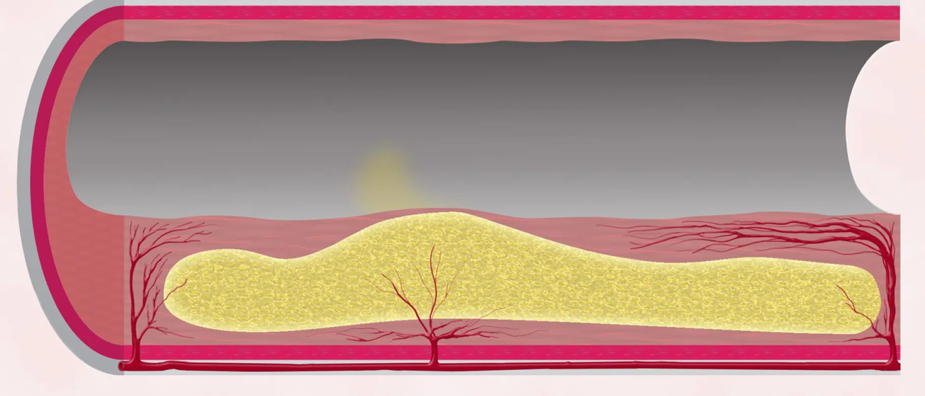 The illustration shows an arterial plaque. The yellow area is the lipid core. Blood vessels are unable to reach the center area,